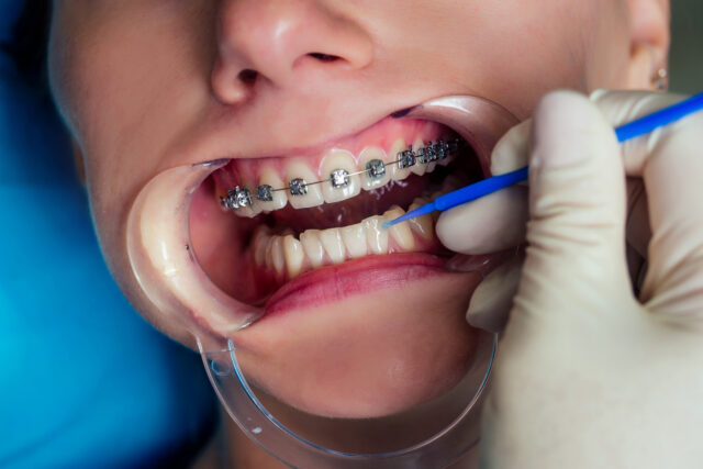Orthodontics Crooked Teeth Treatment in Turkey