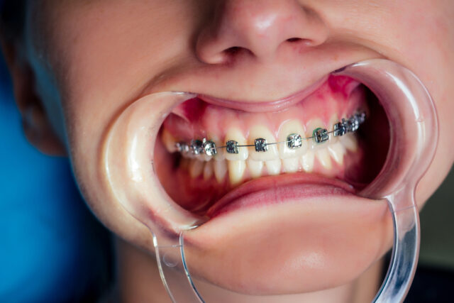 Orthodontics Crooked Teeth Treatment in Turkey